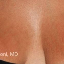 ResurFX Before & After Patient #6529