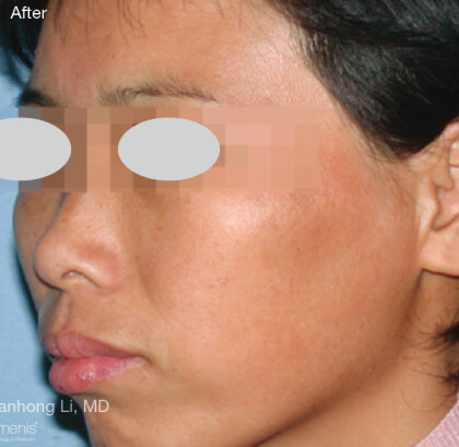 IPL For Pigmentation Before & After Patient #6602