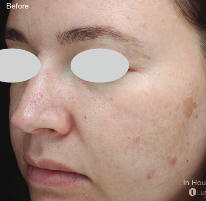 IPL For Pigmentation Before & After Patient #6599