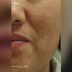 IPL For Pigmentation Before & After Patient #6596