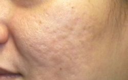 ResurFX Before & After Patient #6646