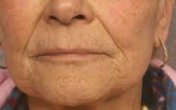ResurFX Before & After Patient #6649