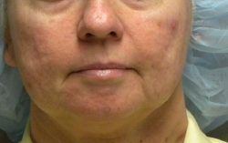 ResurFX Before & After Patient #6643