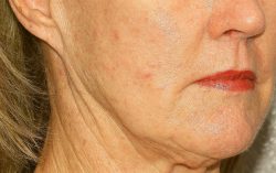 ResurFX Before & After Patient #6652