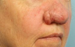 ResurFX Before & After Patient #6655