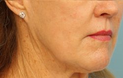 ResurFX Before & After Patient #6652