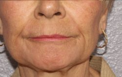 ResurFX Before & After Patient #6649