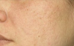 ResurFX Before & After Patient #6646