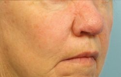 ResurFX Before & After Patient #6655