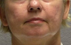 ResurFX Before & After Patient #6643