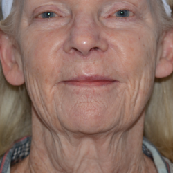Y Lift Before & After Patient #6706
