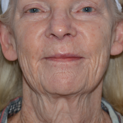 Mini Facelift Before & After Patient #6706