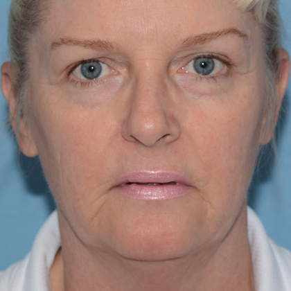 Juvederm Voluma Before & After Patient #6709