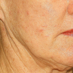 Active & Max FX Laser Before & After Patient #6715