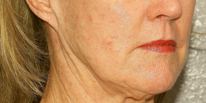 Active & Max FX Laser Before & After Patient #6715