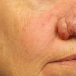 Active & Max FX Laser Before & After Patient #6718