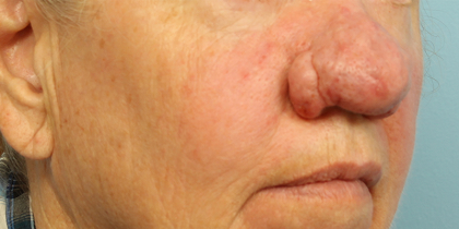 Active & Max FX Laser Before & After Patient #6718