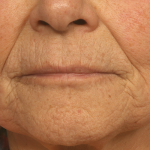 Active & Max FX Laser Before & After Patient #6725