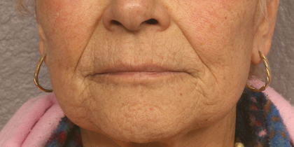 Active & Max FX Laser Before & After Patient #6725