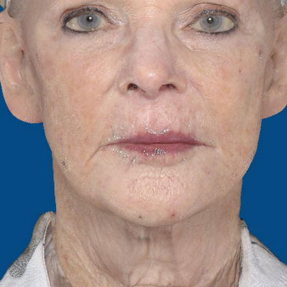 Mini Facelift Before & After Patient #6706