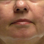 Active & Max FX Laser Before & After Patient #6712