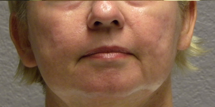 Active & Max FX Laser Before & After Patient #6712