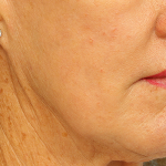 Active & Max FX Laser Before & After Patient #6715