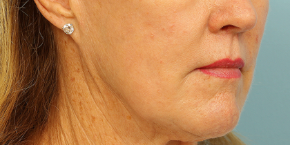 Active & Max FX Laser Before & After Patient #6715