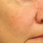 Active & Max FX Laser Before & After Patient #6718