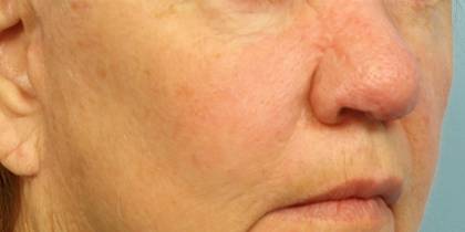 Active & Max FX Laser Before & After Patient #6718
