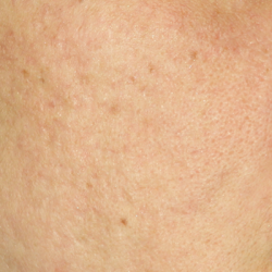 Active & Max FX Laser Before & After Patient #6721