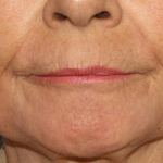 Active & Max FX Laser Before & After Patient #6725