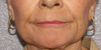 Active & Max FX Laser Before & After Patient #6725