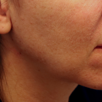 Juvederm Voluma Before & After Patient #6856