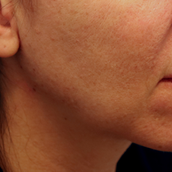 Juvederm Voluma Before & After Patient #6856