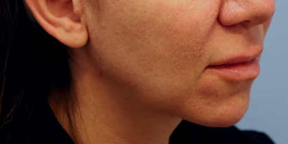 Juvederm Voluma Before & After Patient #6856