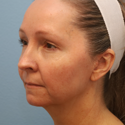 Y Lift Before & After Patient #6853