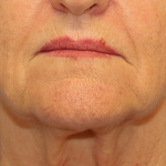 Mini Facelift Before & After Patient #6862