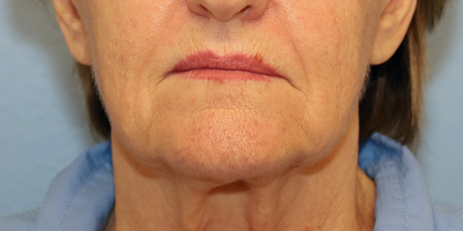 Mini Facelift Before & After Patient #6862