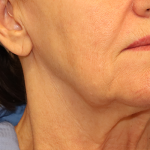 Mini Facelift Before & After Patient #6862