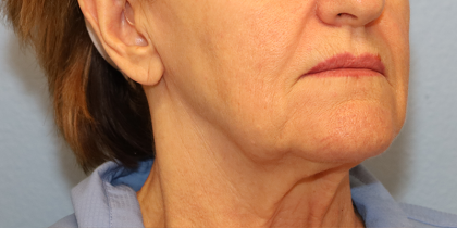 Mini Facelift Before & After Patient #6862