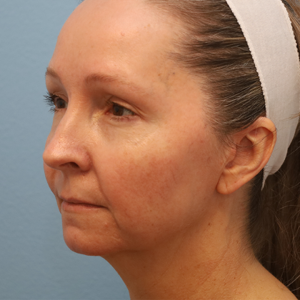 Juvederm Voluma Before & After Patient #6853