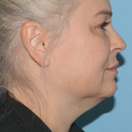 Mini Facelift Before & After Patient #6867