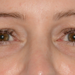 Lower Blepharoplasty Before & After Patient #6872