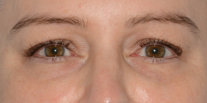 Lower Blepharoplasty Before & After Patient #6872