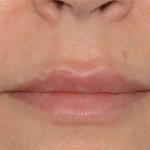 Juvederm Volbella Before & After Patient #6875