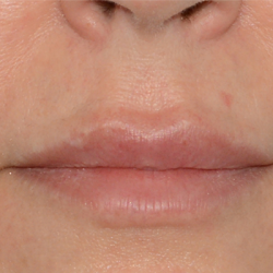 Volumize Before & After Patient #6875