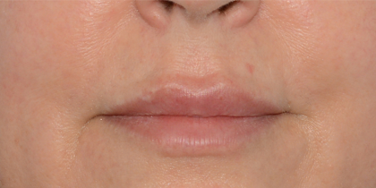 Juvederm Volbella Before & After Patient #6875
