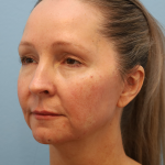 Juvederm Voluma Before & After Patient #6853