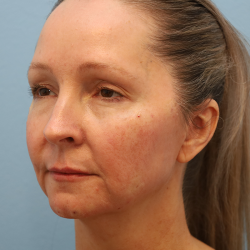 Y Lift Before & After Patient #6853